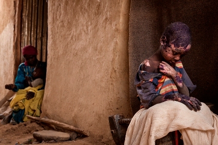 Adam Abdel, age 7, was badly burned when a bomb, dropped on February 12 by a Sudanese government’s Antonov plane, landed next to his family’s home in Burgu, Central Darfur, Sudan, February 27, 2015.